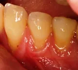 Before Gum Grafting