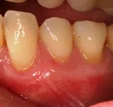 After Gum Grafting