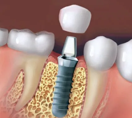 Single tooth implant getting a teeth placed.