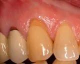 Before Gum Grafting