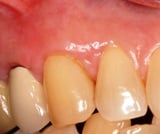 After Gum Grafting