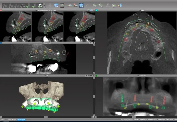 coDiagnostiX treatment planning