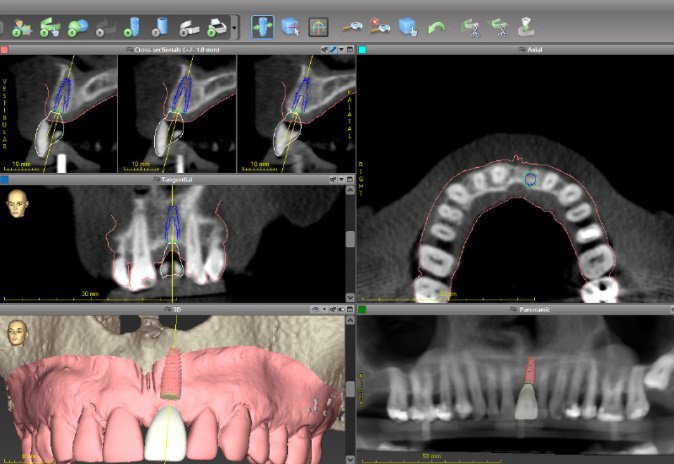 coDiagnostiX treatment planning